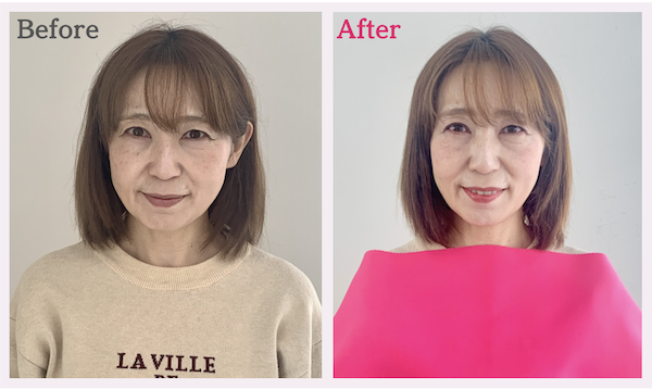 美顔バランス診断の顔タイプ結果が麗×下タイプのビフォーアフター