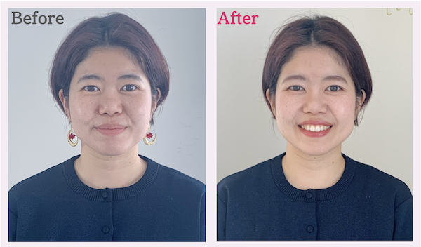 美顔バランス診断の顔タイプ結果が優×上タイプのビフォーアフター